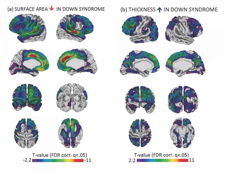 This image shows brain scans of people with Down syndrome.