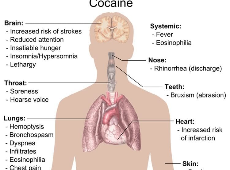 This image is a diagram showing the side effects of cocaine on the body.
