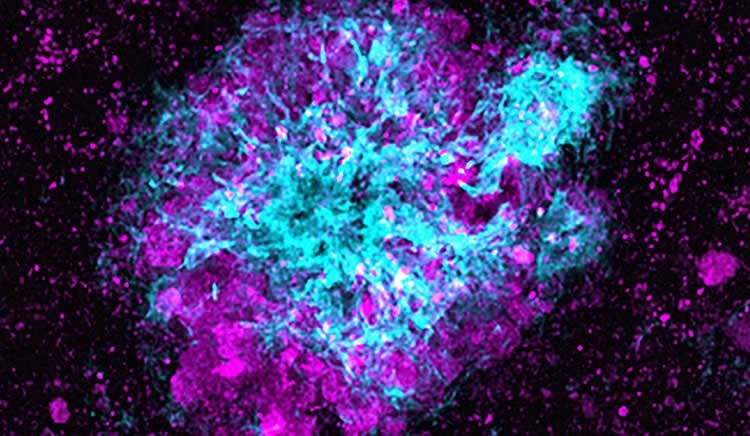 This image shows Lysosomes (in magenta) accumulate near amyloid plaques.