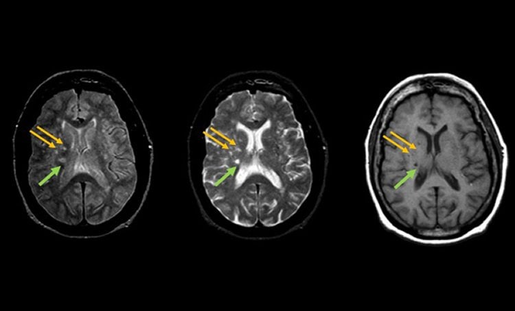 This image shows brain scans with arrows pointing to the lesions.