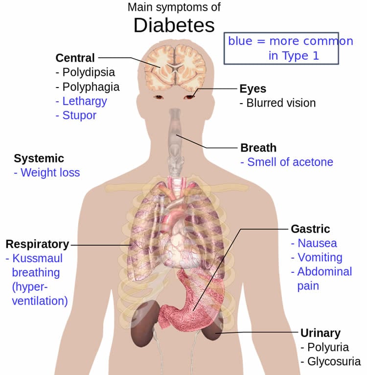 This image shows a diagram of the body. Different parts are labelled showing how diabetes affects the body.