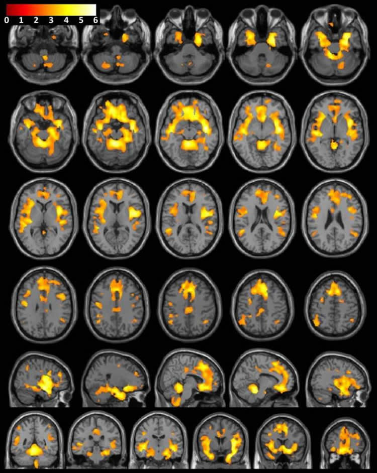 This image shows MRI scans of both the brains of women who abused substances and those who did not.