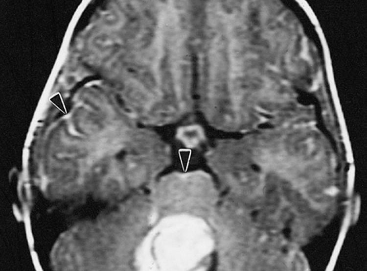 This is an MRI scan of a person with medulloblastoma brain cancer.