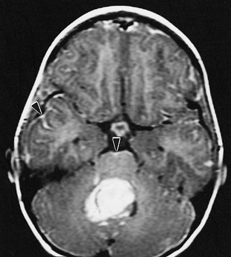 This is an MRI scan of a person with medulloblastoma brain cancer.