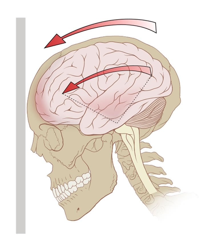 This is a drawing of a skull and brain. There is an arrow above the skull pointing to a wall, as if to signify force.
