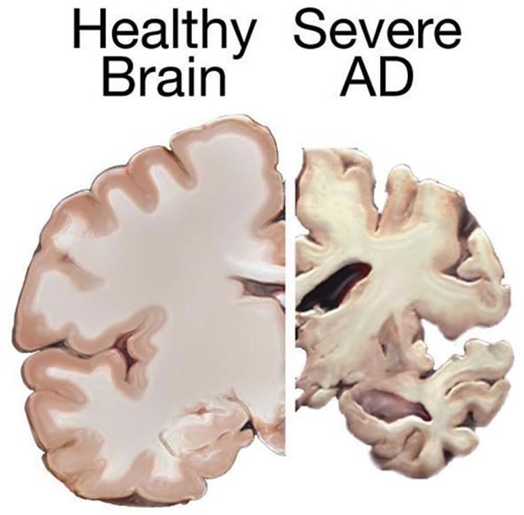 This shows a healthy brain slice and a slice from a brain with Alzheimer's disease.