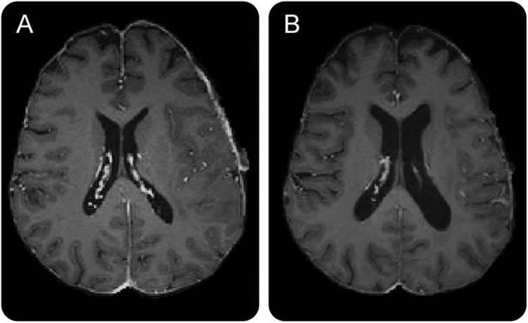 This image shows before and after treatment brain scans for a patient with glioblastoma brain cancer.