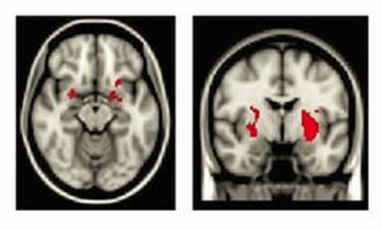 This image shows the regions of the brain where greater activation was noted.