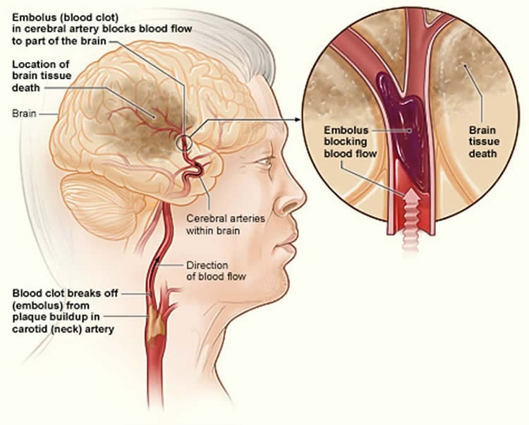 This diagram shows how a stroke can occur.