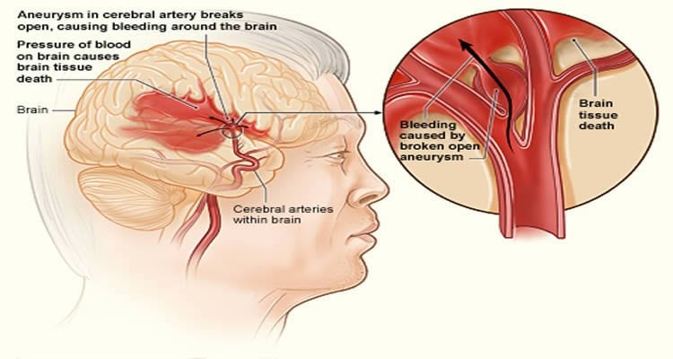 This is an illustration of a blood clot causing a stroke.