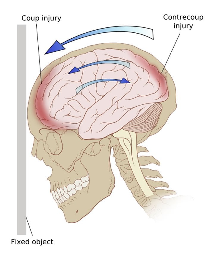 This shows a diagram of the forces on the brain in a coup-contrecoup injury.