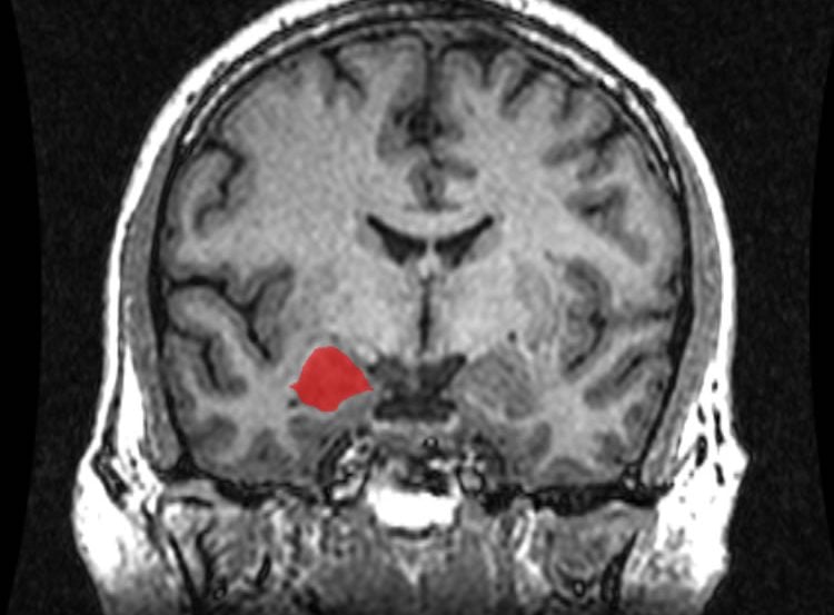 Image shows an MRI brain scan with the amygdala highlighted.