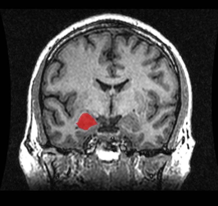 Image shows an MRI brain scan with the amygdala highlighted.