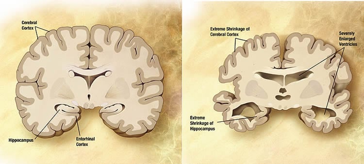 Illustration of a healthy brain slice and a brain slice from a person with Alzheiemr's.