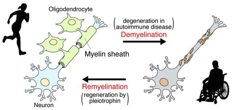 Image illustrates how demyelination and remyelination occur.