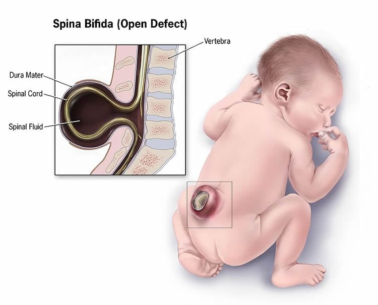 Diagram of a newborn babsy with an open defect spinal bifida.