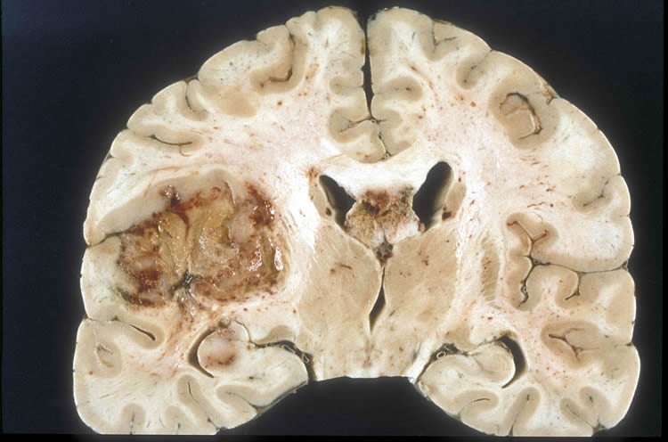 Image shows a brain slice with glioblastoma brain cancer.