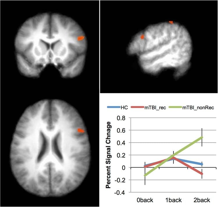 Image shows brain scans from the study.