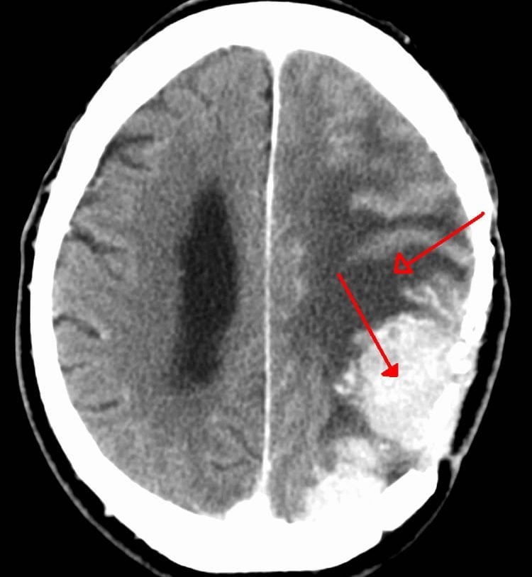 Image of a brain scan of a person with meningioma brain cancer.