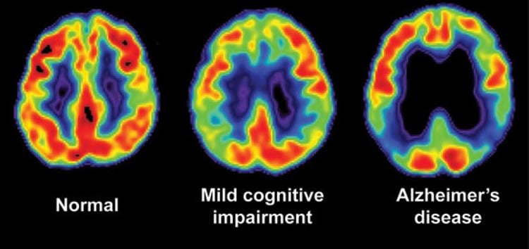 Image shows three brain scans. One is of a normal brain, one from a person with MCI and one from a person with Alzheimer's disease.