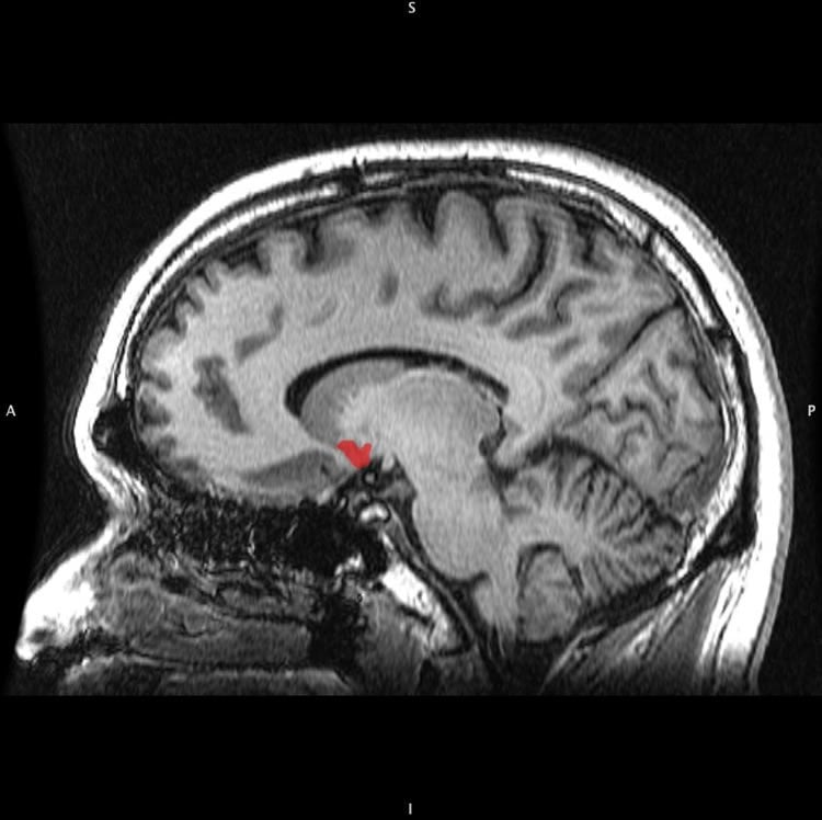 Image shows a sagittal MRI slice with highlighting (red) indicating the nucleus accumbens.