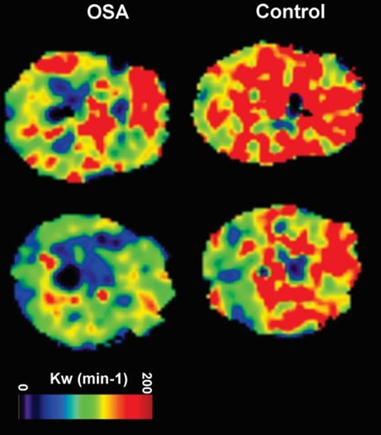 Images are brain scans of people with OSA and without OSA.