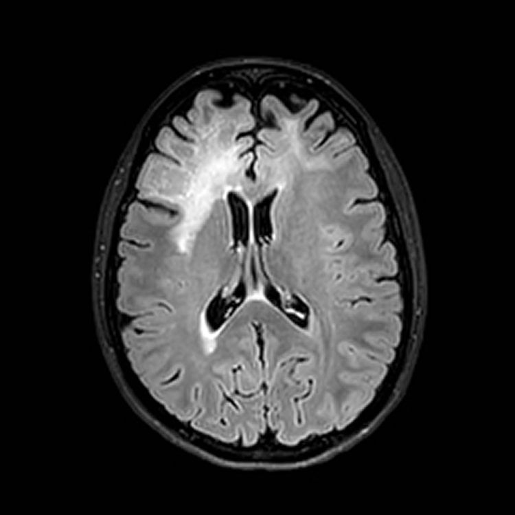Brain scan of a patient with MS suffering from PML.