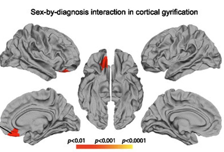 Image shows five brain slices. The caption best describes the image.