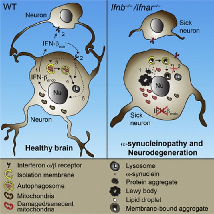 Diagram of a healthy neuron and one from a Parkinson's patient.