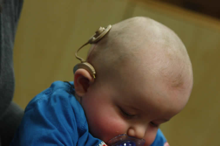 Photo of a baby with a cochlear implant.