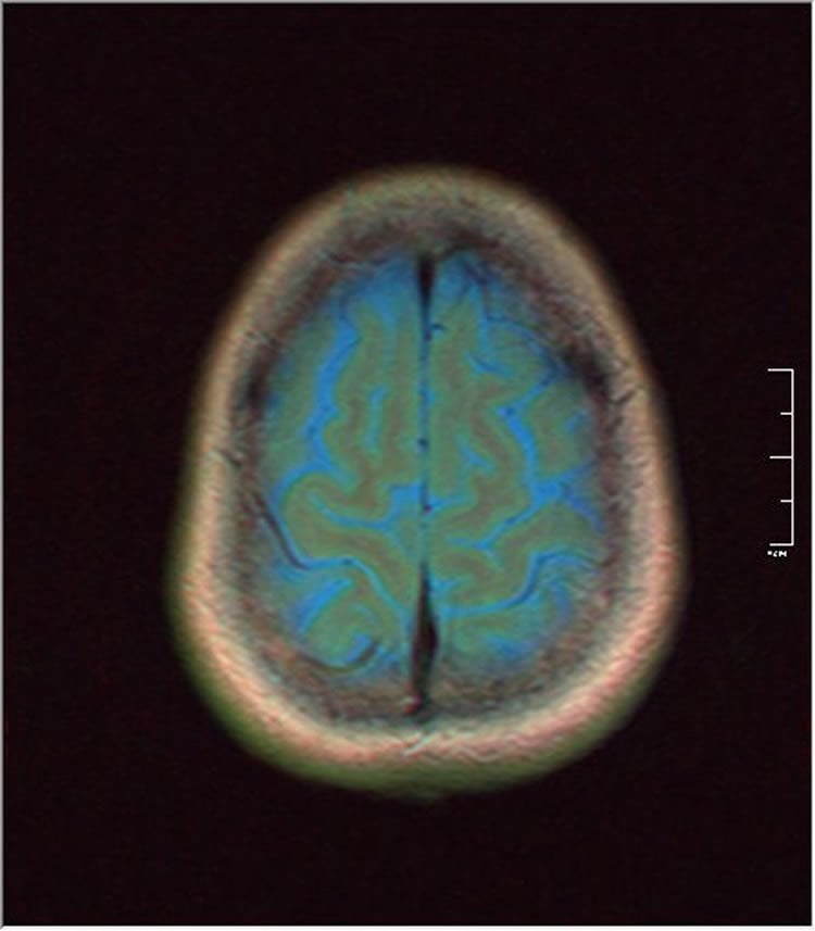 MRI brain scan of a glioma patient.