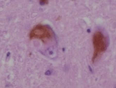 Image shows Lewy bodies.