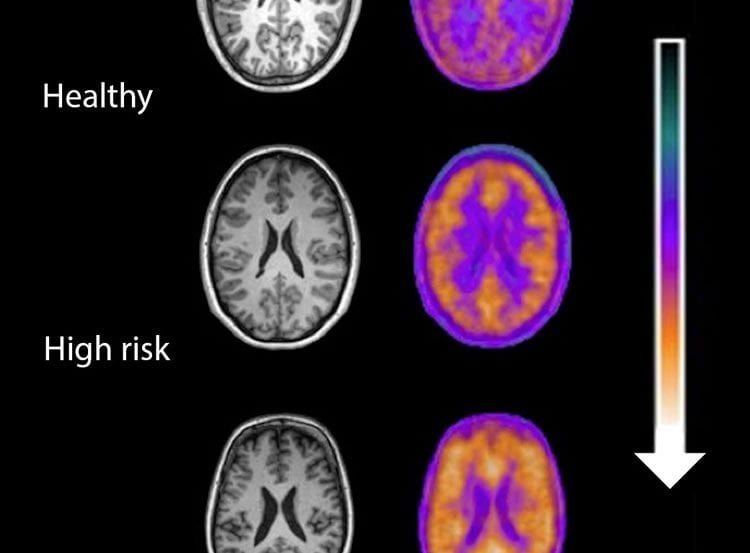 Brain scans of people at risk of developing schizophrenia.
