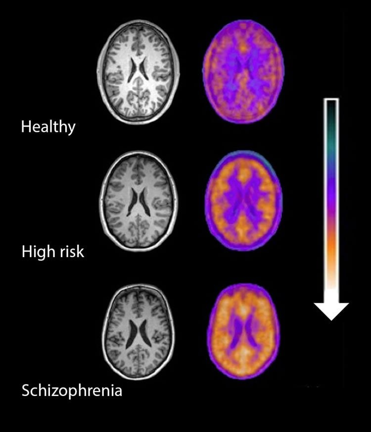 Brain scans of people at risk of developing schizophrenia.