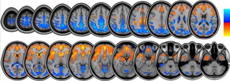 Image shows brain scans displaying the volume changed during the head down bed tilt rest experiment.