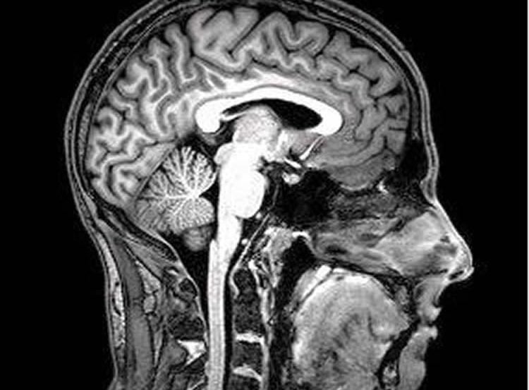 Image shows an fmri brain scan.