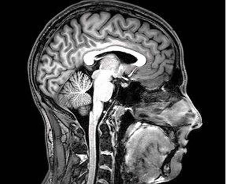 Image shows an fmri brain scan.