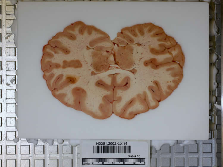 Photo shows a brain slice.