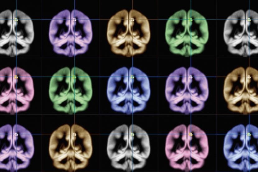 MRI brain scans in rainbow colors.