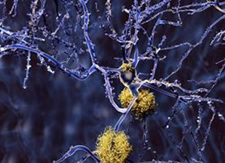 Image of amyloid plaques.