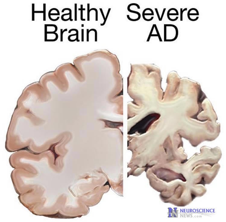 Image shows a normal brain slice and a brain slice from an alzheimer's patient.