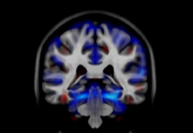 Image shows a brain scan from a person with alcohol dependencies.