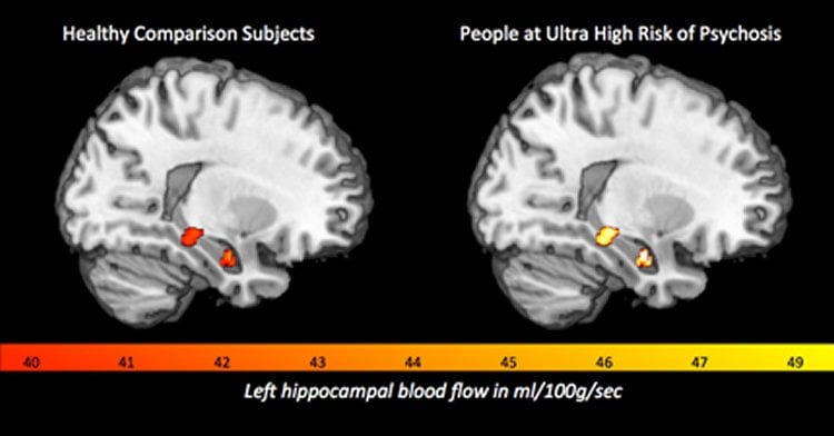 Image shows a brain scans with the hippocampus highlighted.
