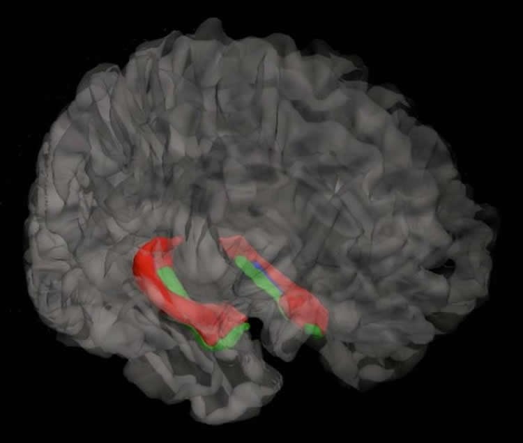 Image of a brain scan with the hippocampus highlighted.