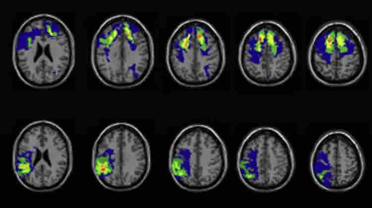Brain scans taken from this study.
