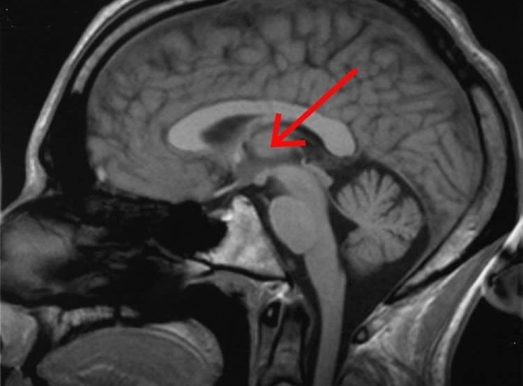 Brain scan with a red arrow pointing to the thalamus.