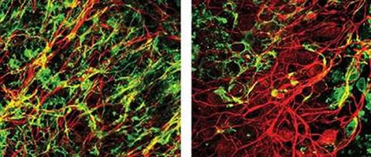 Image shows myelinated and demyelinated neurons.