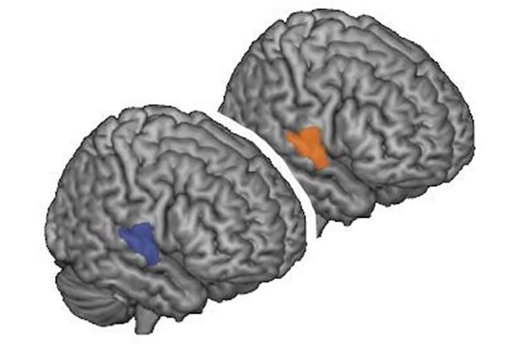 Image shows location of right superior temporal gyrus in the human brain.