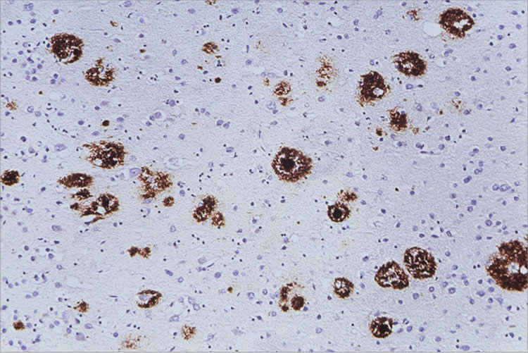 Image shows amyloid beta in the cerebral cortex.