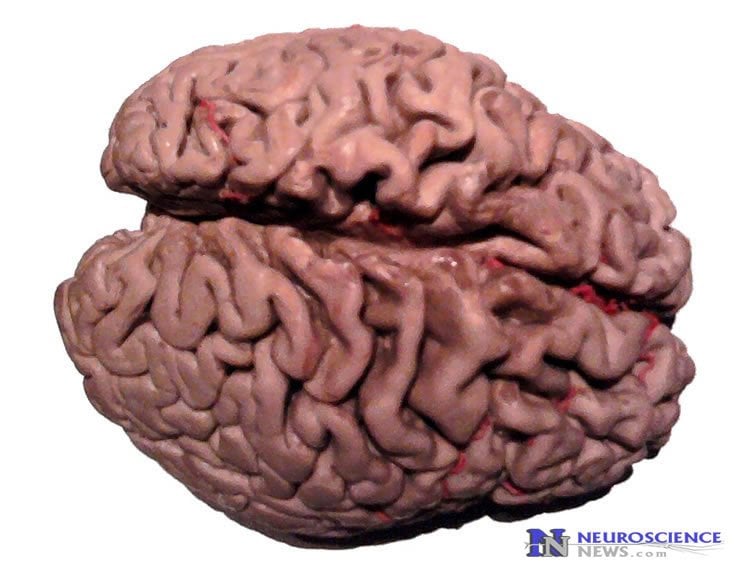 Image shows a plastinated alzheimer's brain.